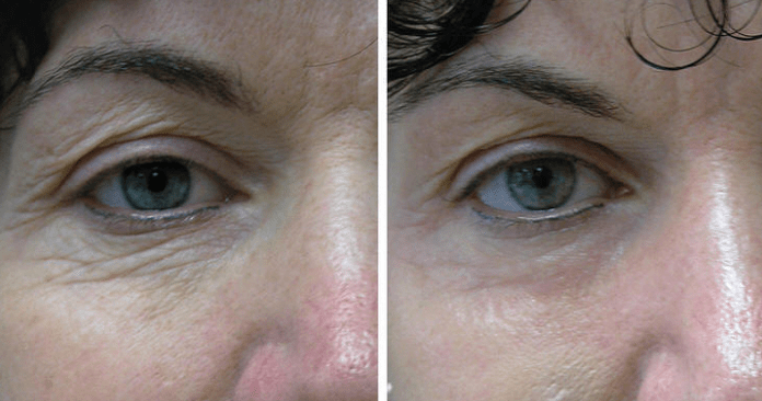 Skin laser around the eyes