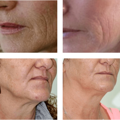 Laser rejuvenation