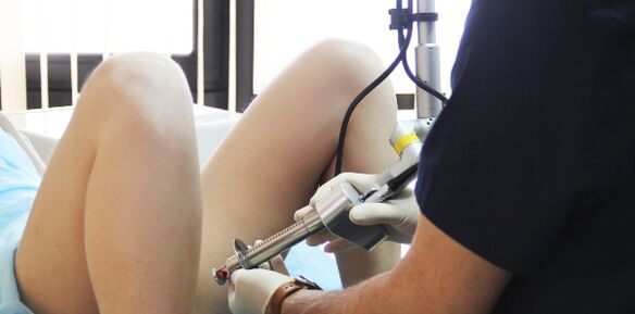 Laser removal of warts
